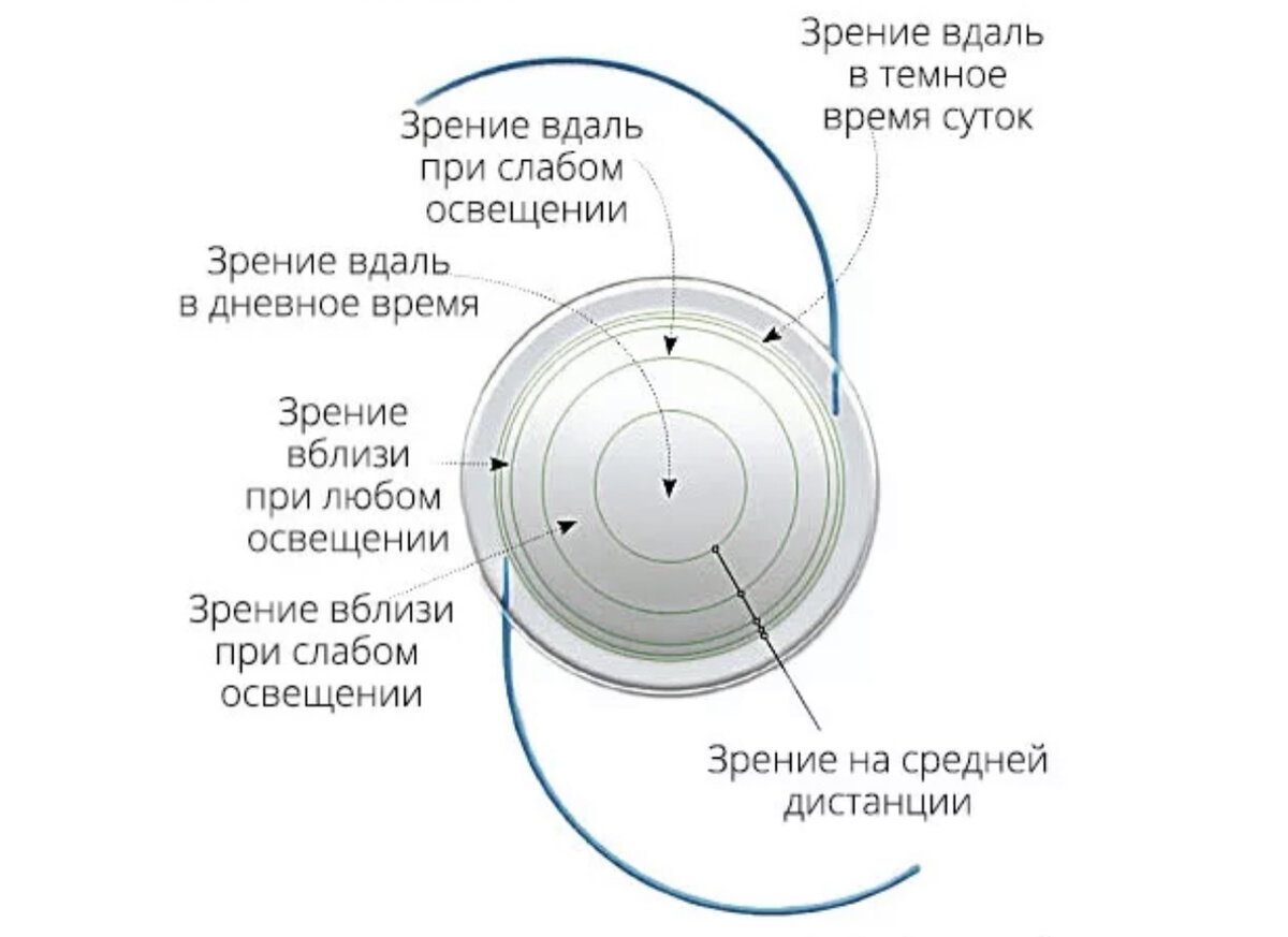 Что такое искусственный хрусталик?Какие бывают искусственные хрусталики ?Как  выбрать для себя и не пожалеть ? | Медицина для всех,полезный канал. | Дзен