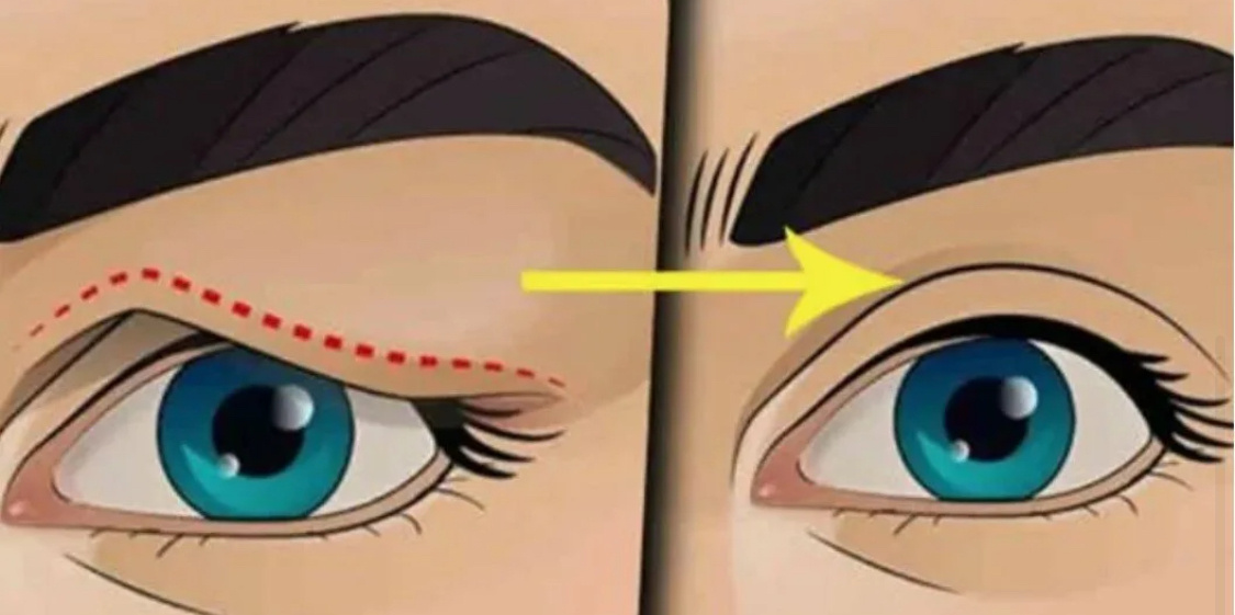 Метод веки. Радиоволновой скальпель сургитрон. Метод веки. Кантопластика верхних век. Метод веки.