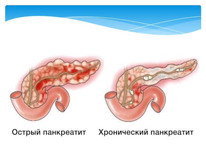 У меня диагноз – панкреатит: почему пострадала поджелудочная железа ...