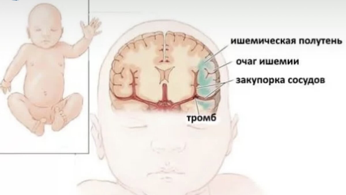 Отёк мозга у новорождённого ребёнка. Сосудистые аномалии у новорожденных. Гипоксии мозга у детей до года симптомы. Врожденная аномалия сосудов у детей.