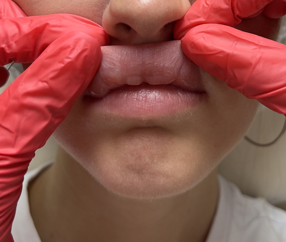 До разрушения( миграция филлера на сторону ротовой полости 