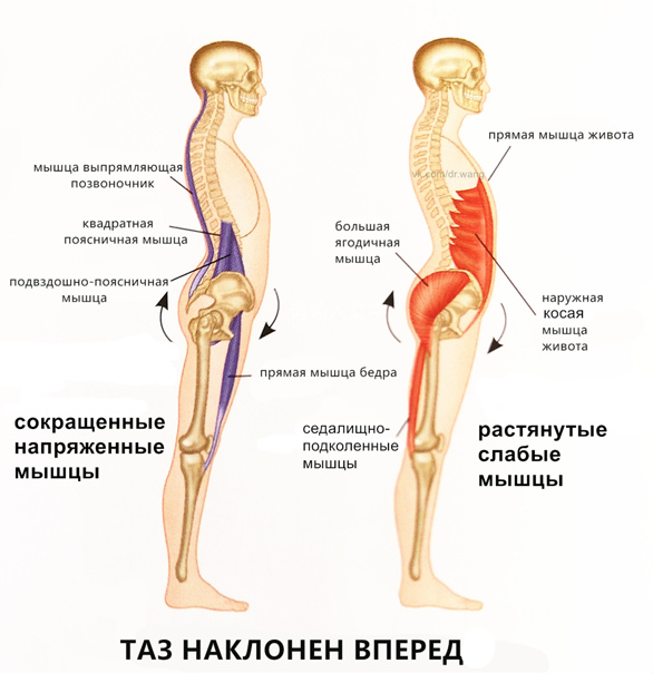 Гиперлордоз