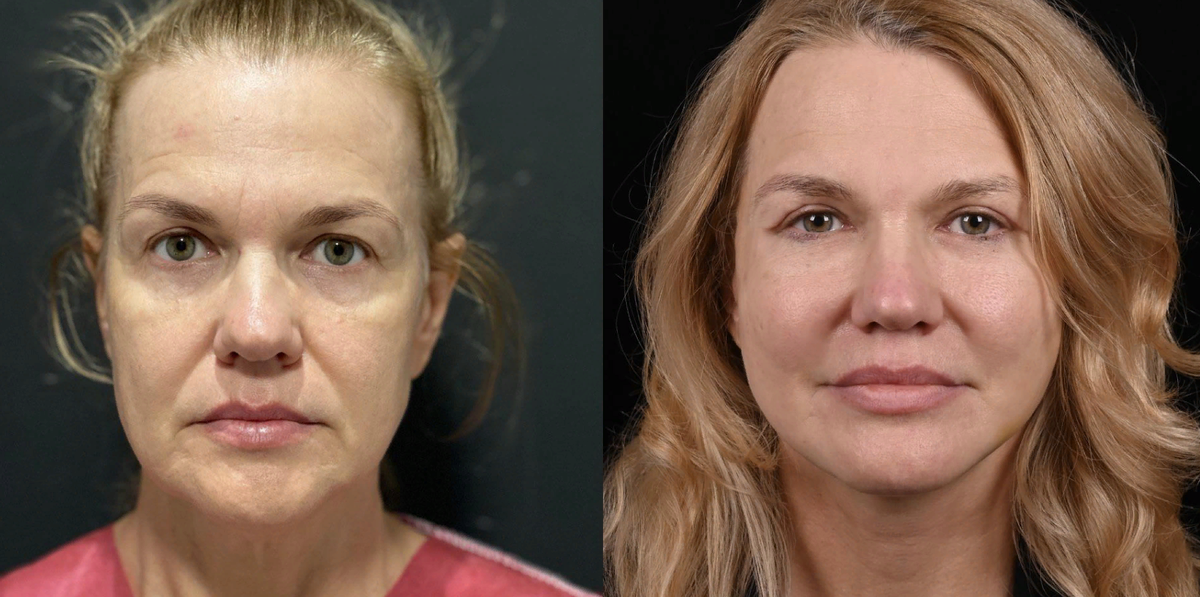 Janice Dickson Haircut and color, Celebrity plastic surgery, Old celebrities