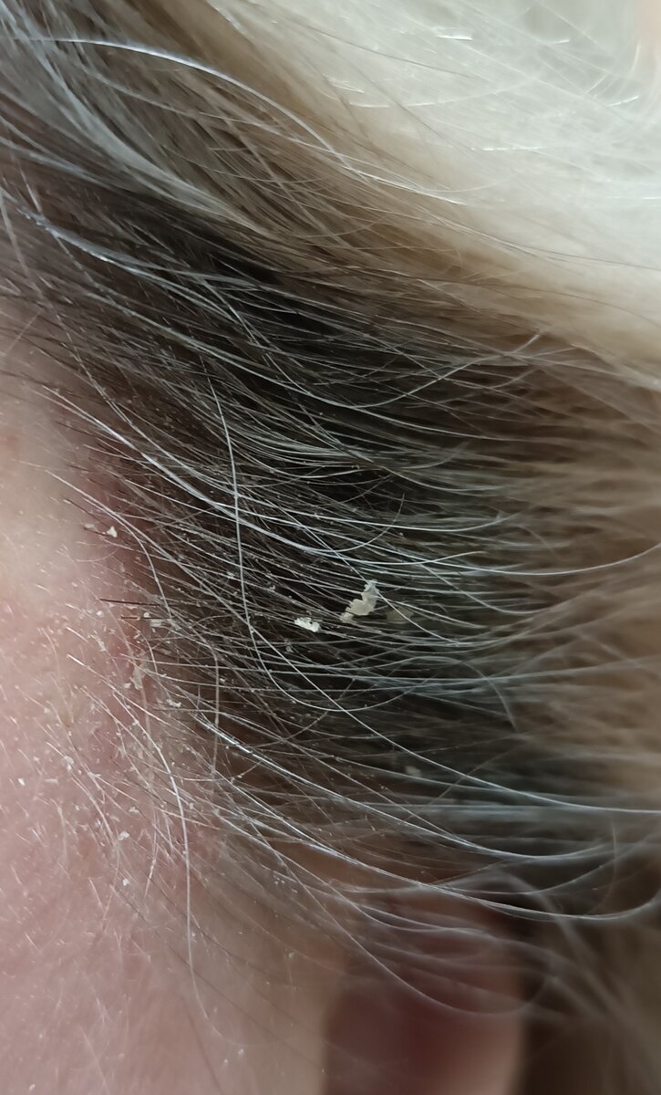 Корочки в волосах