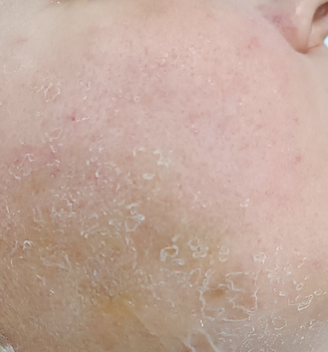 Чешуйчатое шелушение кожи лица