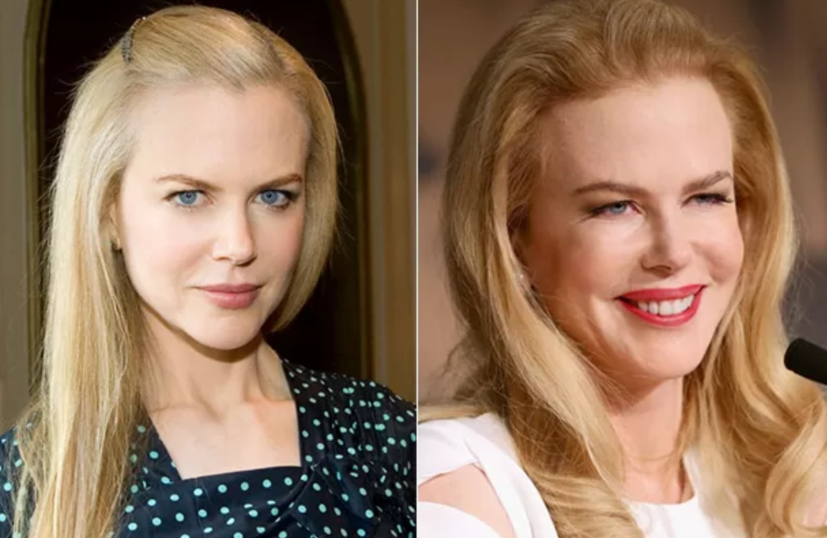 Николь Кидман до и после ботокса