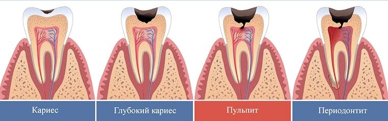 Стадии развития зубных заболеваний