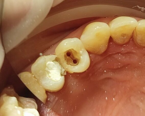 Лечение корневых каналов