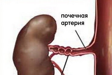 Фибромускулярная дисплазия выглядит так. Почечные артерии сужены из-за генетического дефекта их развития. 