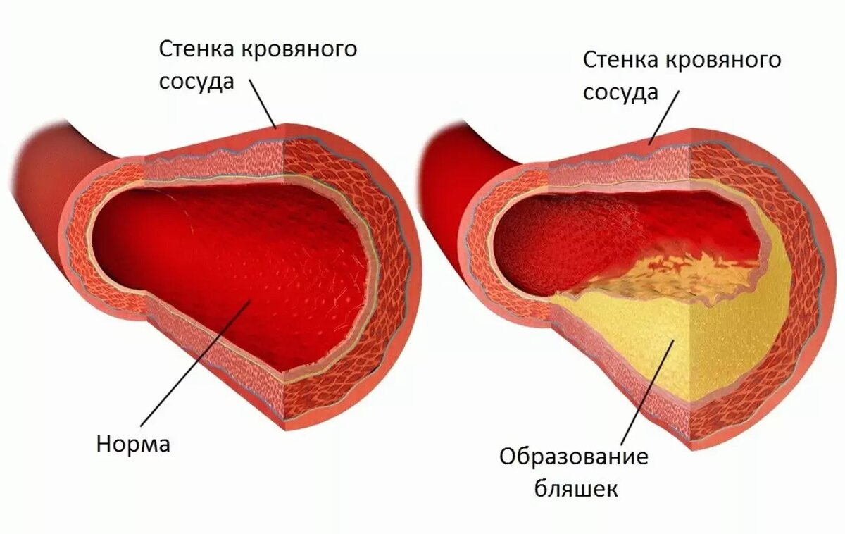 Бляшки представляют собой образования в стенке сосуда, состоящие из холестерина, кальция, коллагеновых волокон, гладкомышечных клеток, макрофагов. Фото: serg-crb.ru