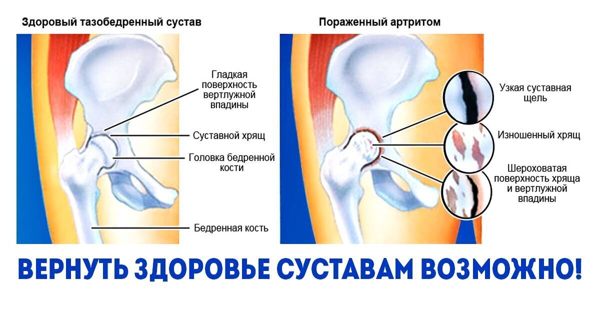 От чего болят тазобедренные суставы у женщин. Воспаление тазобедренного сустава. Артрит бедренного сустава симптомы инфекционный.