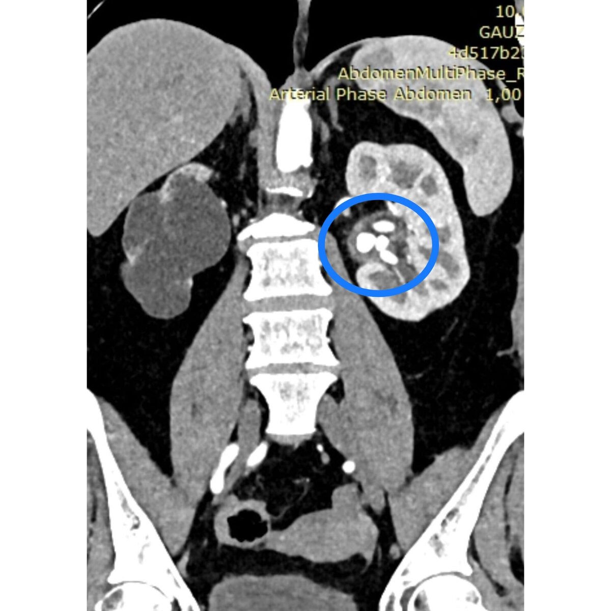 Множественные камни в почке на снимке КТ 