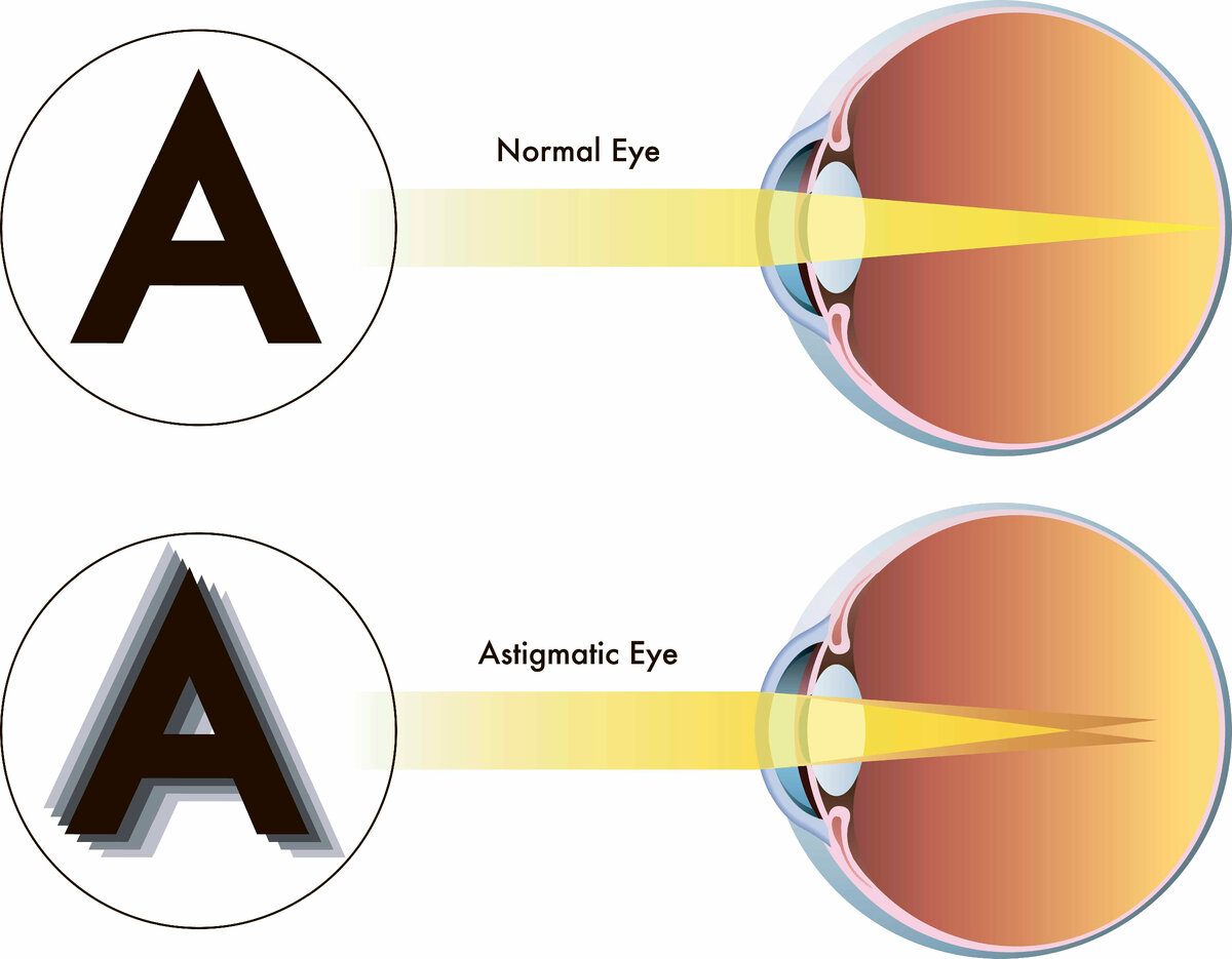 Двоение в глазах - один из основных симптомов астигматизма.