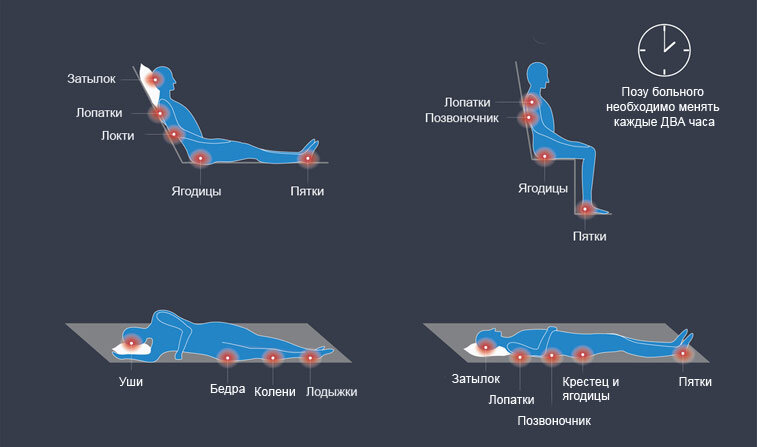 Места образования пролежней в зависимости от позы больного