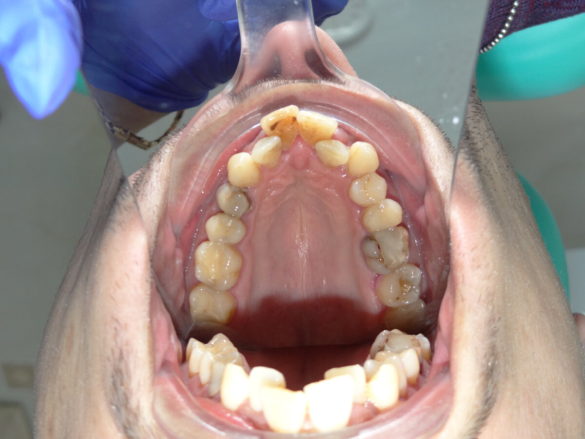 Фото верхней челюсти: частая ортодонтическая  проблема  - это узкая верхняя челюсть. После анализа состояния зубов были выявлены требующие лечения.