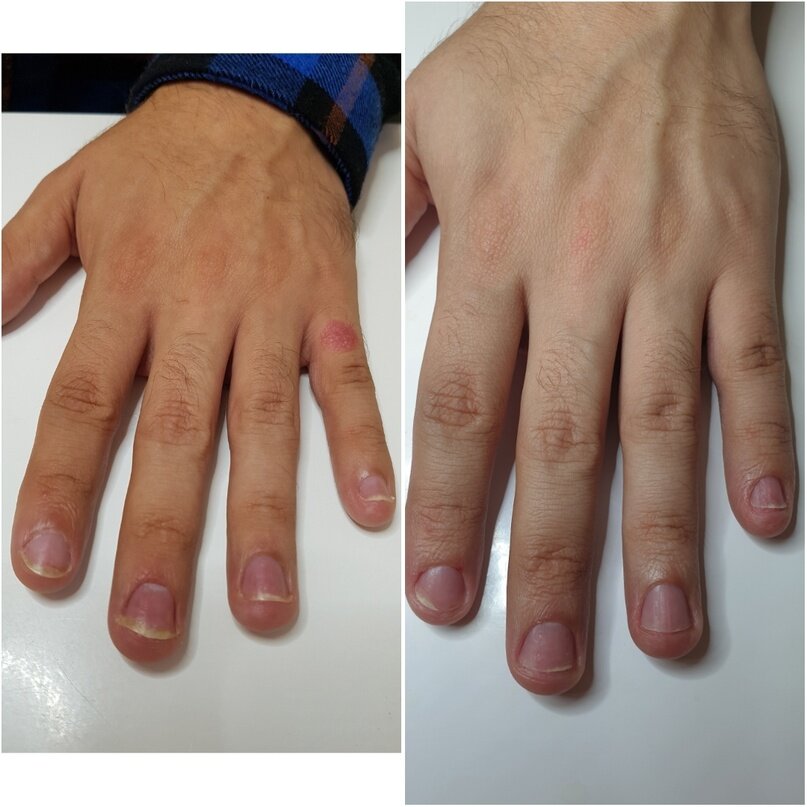 Псориаз ногтя, лечение