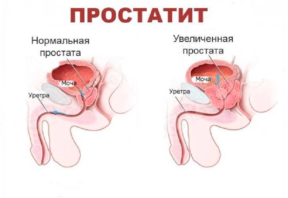 Mediton Clinic - ГЕМОРРОЙ И ПРОСТАТИТ. ОПАСНАЯ ВЗАИМОСВЯЗЬ