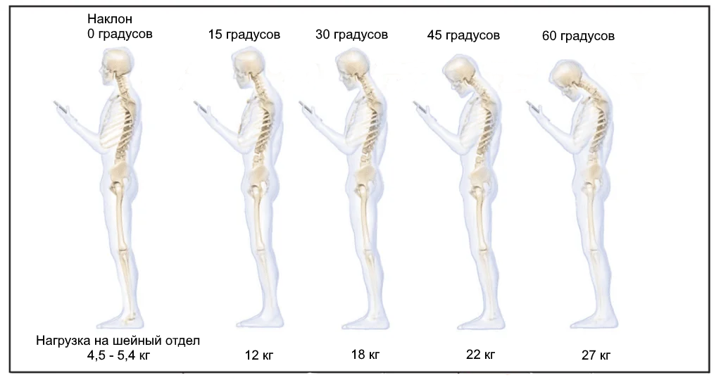 *1 Hansraj, K.K. Assessment of stresses in the cervical spine caused by posture and position of the head. Surgical Technology International, 25, 2014.