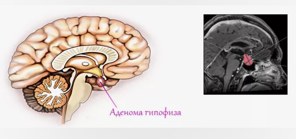 Соматотропная аденома гипофиза. Опухоль микроаденома гипофиза. Эндоселлярная аденома гипофиза головного мозга. Интраселлярной аденомы гипофиза.