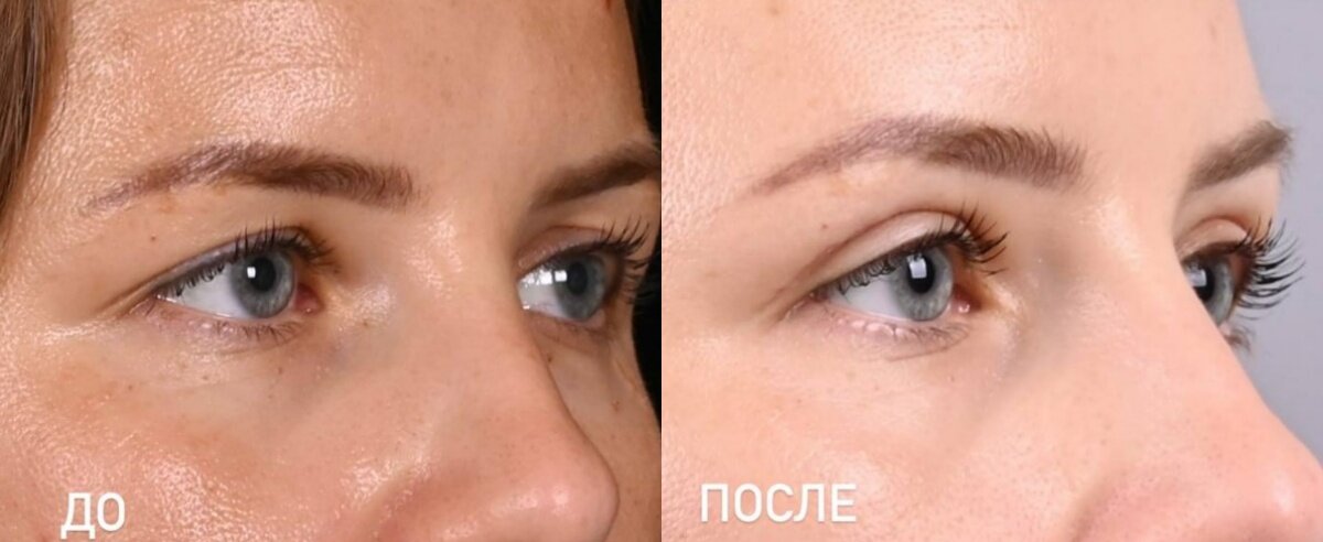 Блефаропластика верхних век с липофилингом. Фото до и после. Фото с сайта хирурга Д.Р. Гришкяна. Имеются противопоказания, требуется консультация специалиста