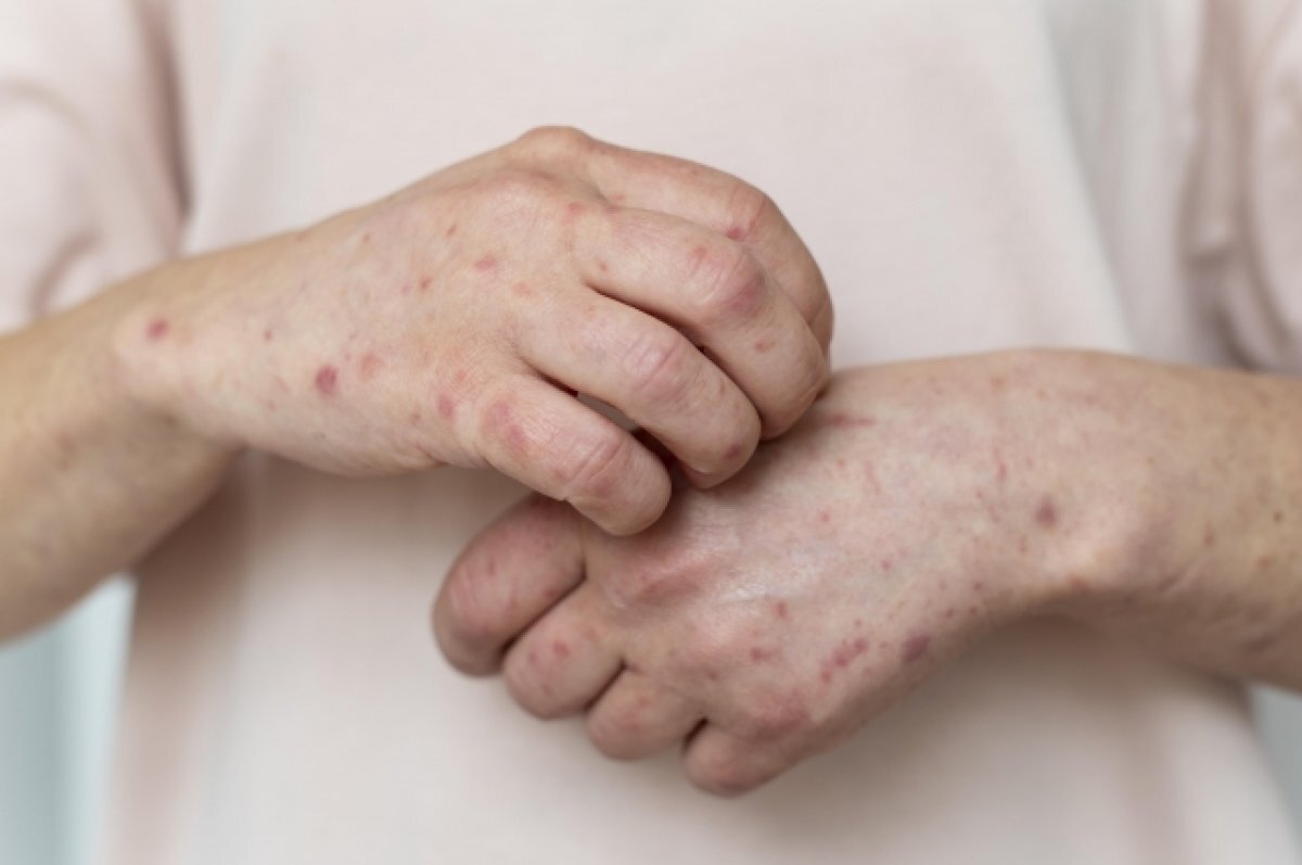    44 калининградца заболели корью в текущем году