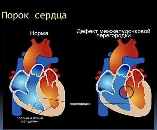 Норма и дефект межжелудочковой перегородки (порок сердца). 