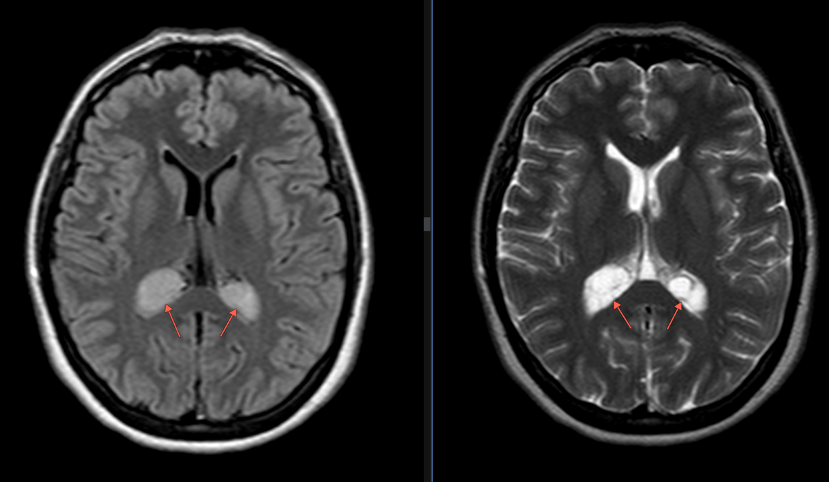 Рис.1 Пациент А.: Flair и Т2-ВИ аксиальная плоскость (слева направо): В области сосудистых сплетений задних рогов боковых желудочков с обеих сторон определяются гиперинтенсивные образования, размером справа - 1.9х2.8х2.3 см, слева - 1.8х2.1х1.9 см (двусторонние ксантогранулёмы).