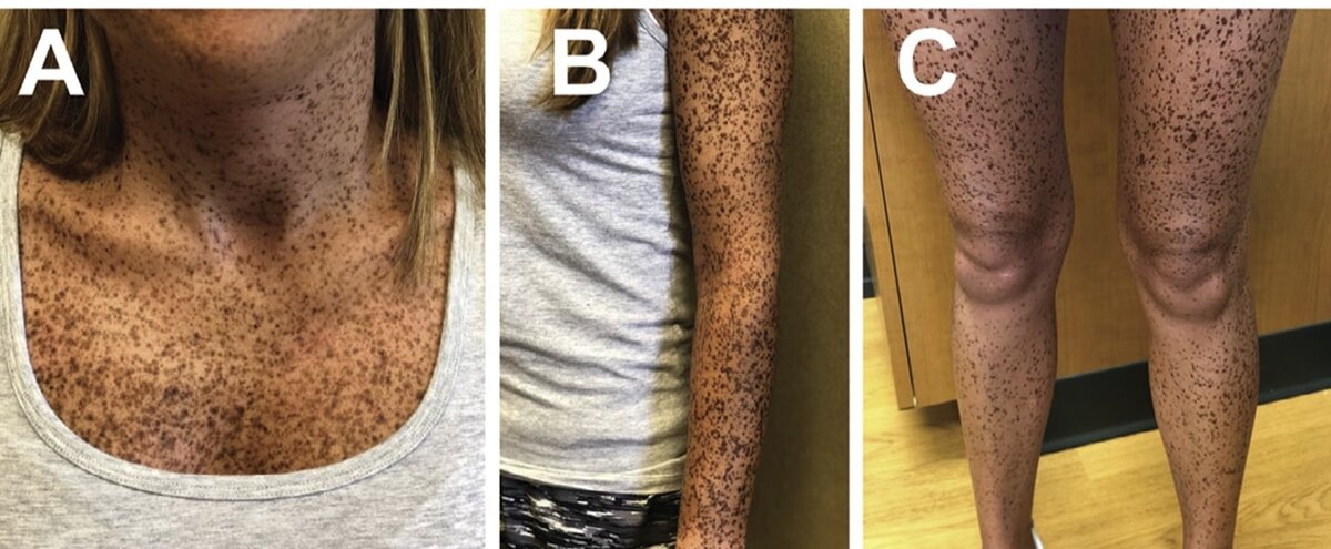 На фото представлены пигментные пятна по типу лентиго, напоминающие темные веснушки