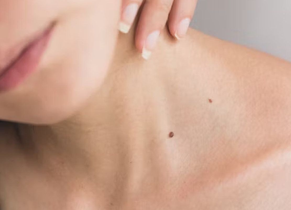 Врач-дерматолог Татьяна Кузьмина: плоские образования на коже чаще оказываются злокачественными, чем узловые.