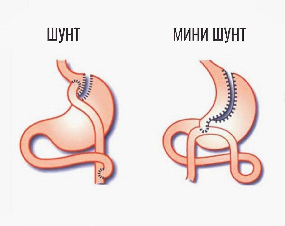 лапароскопическое шунтирование желудка. билиопанкреатическое шунтирование. шунтирование желудка что это. желудочное шунтирование схема. шунтирование желудка и резекция желудка.
