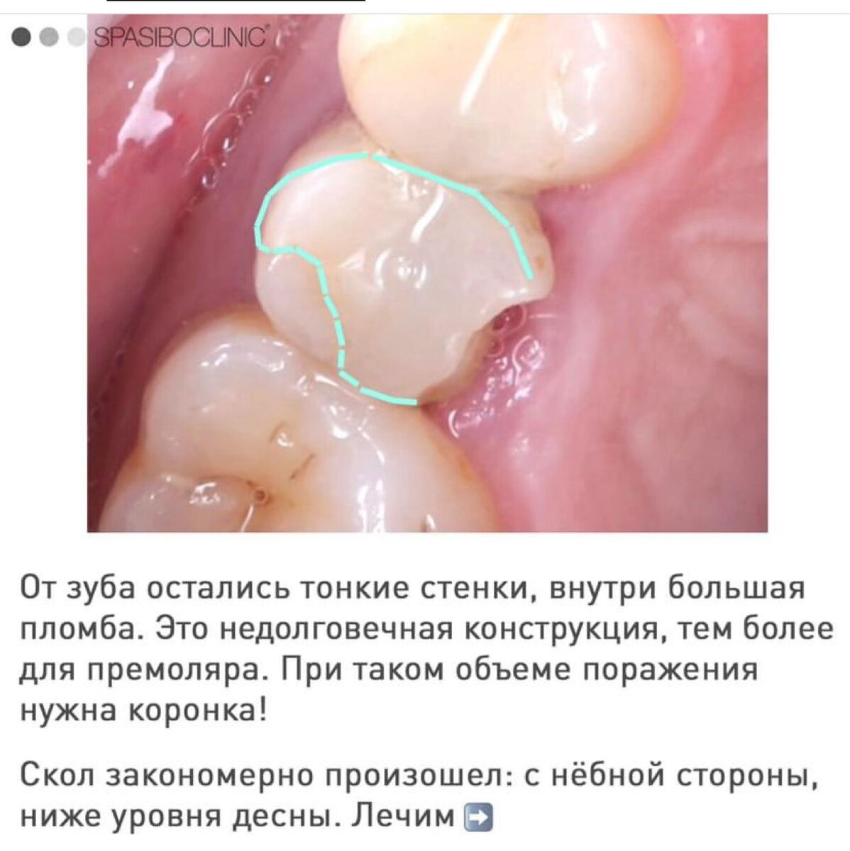 Почему лучше восстановление зубов коронкой, а не пломбой?