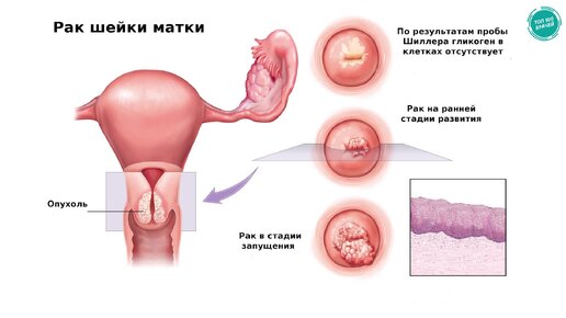 Рак шейки матки