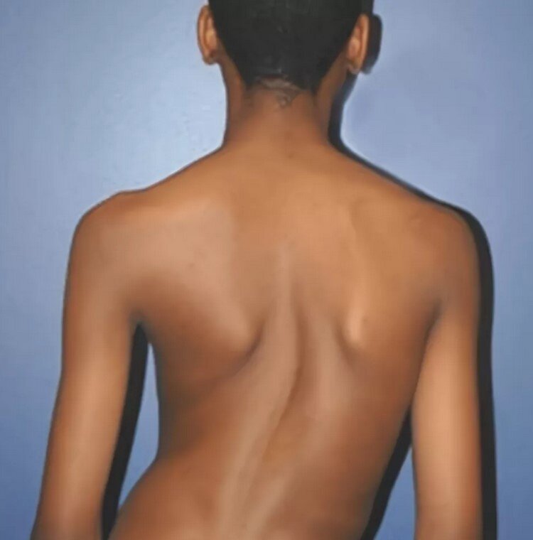 сколиоз у подростка