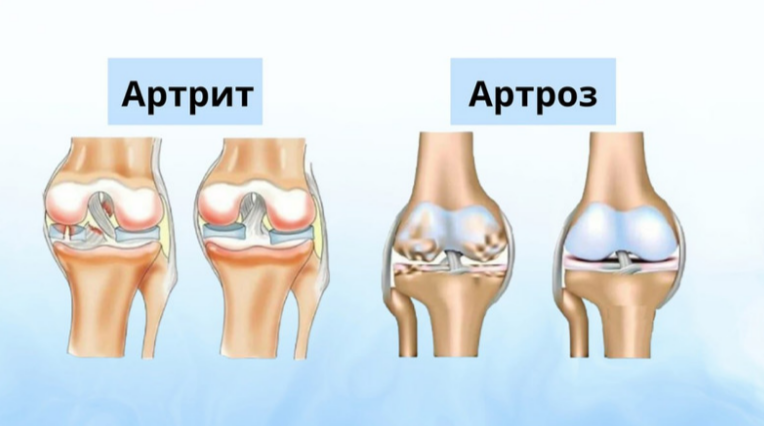 В чём разница между артритом и артрозом Это во многом вопрос терминологии. С тер