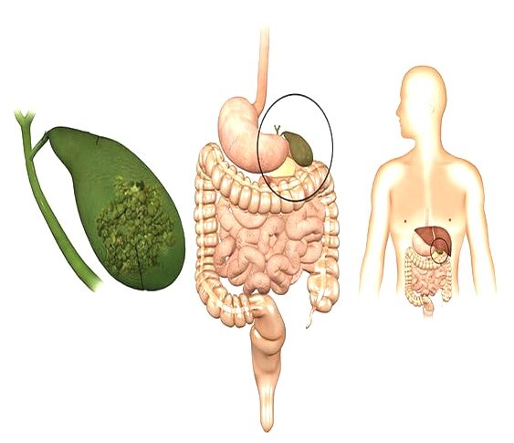 От чего появляются камни в желчном пузыре