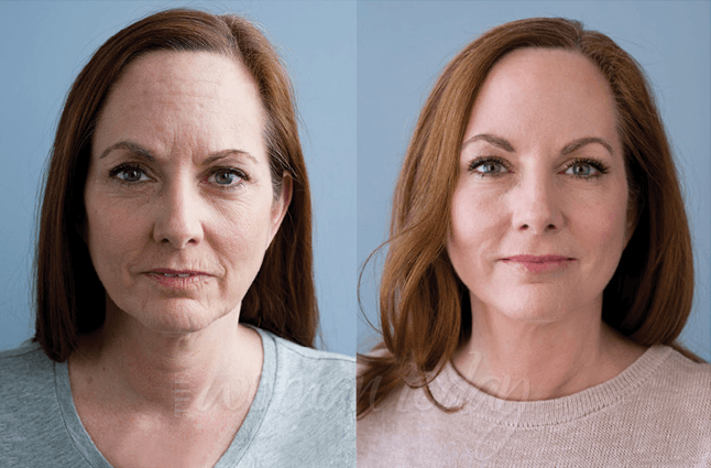 6 месяцев гормональной терапии