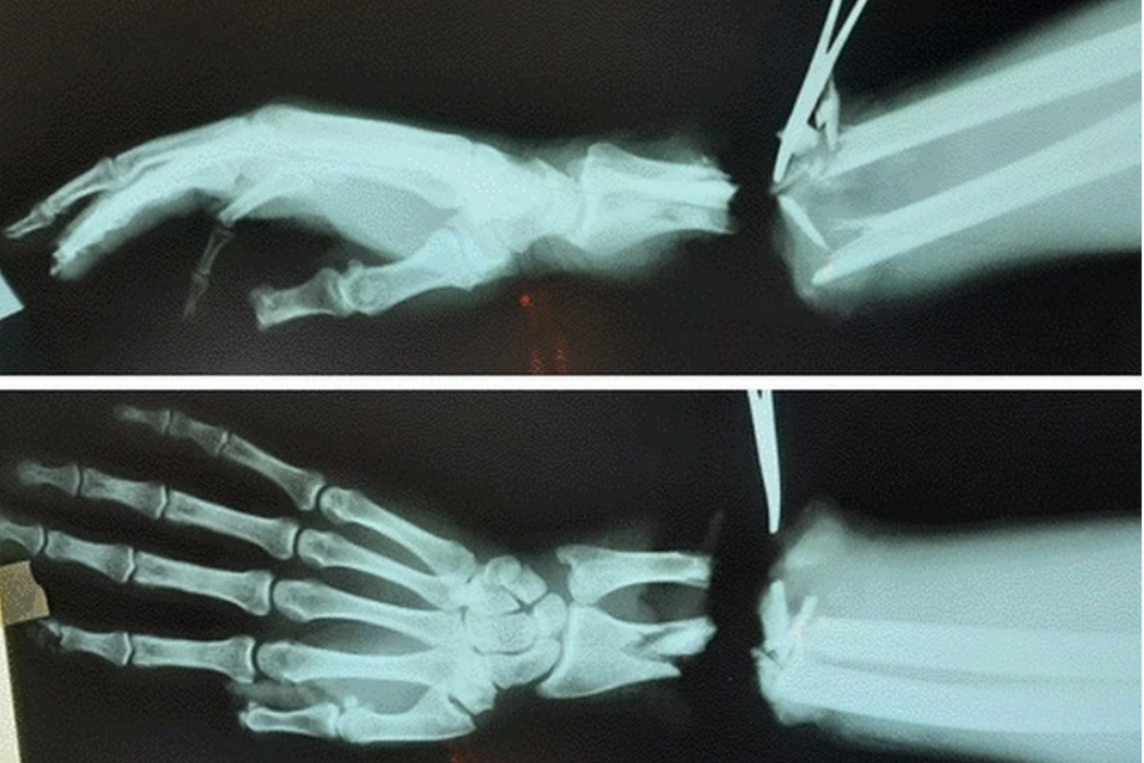    Фото предоставлено НМИЦ ТО им. акад. Г.А. Илизарова Минздрава России Дмитрий Зайцев