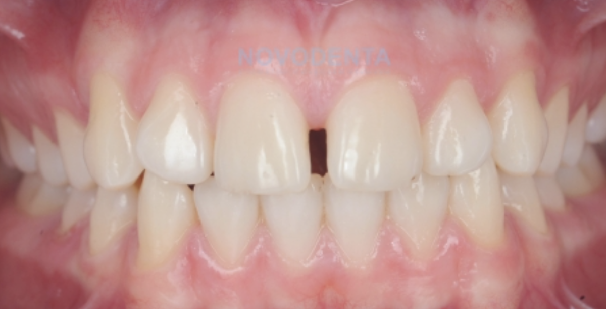 Пример диастемы