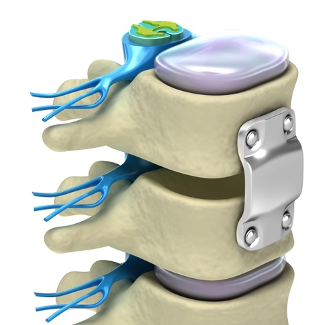  Артропластика шейного диска (также известная как искусственная замена диска) — это хирургическая процедура, позволяющая уменьшить давление на спинной мозг и нервные корешки путем замены...