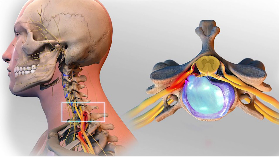  Артропластика шейного диска (также известная как искусственная замена диска) — это хирургическая процедура, позволяющая уменьшить давление на спинной мозг и нервные корешки путем замены...-2