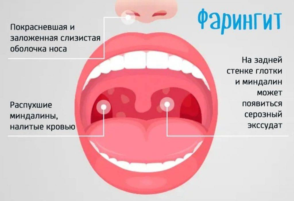 Ангина: фото, симптомы, диагностика и лечение