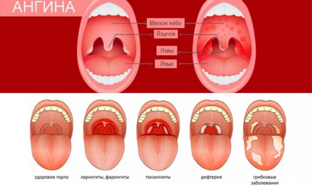 Какое горло при ангине фото у взрослого