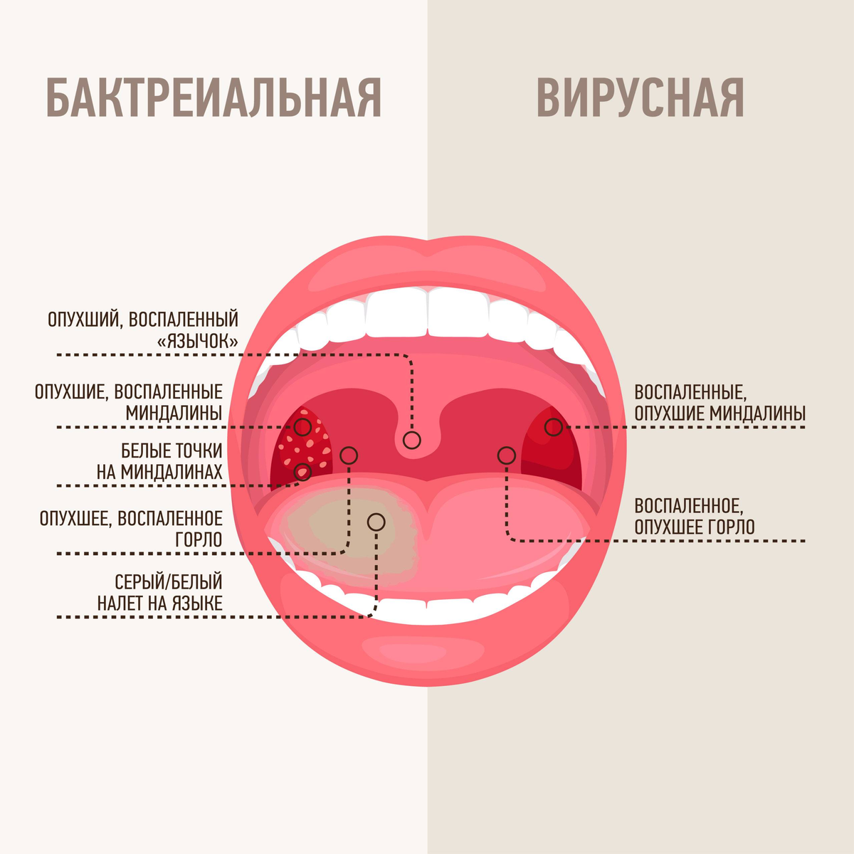 Фарингит у беременных: лечение без вреда для плода | Faringospray | Дзен