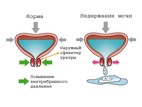 Мочевой пузырь постоянно полный и хочется в туалет