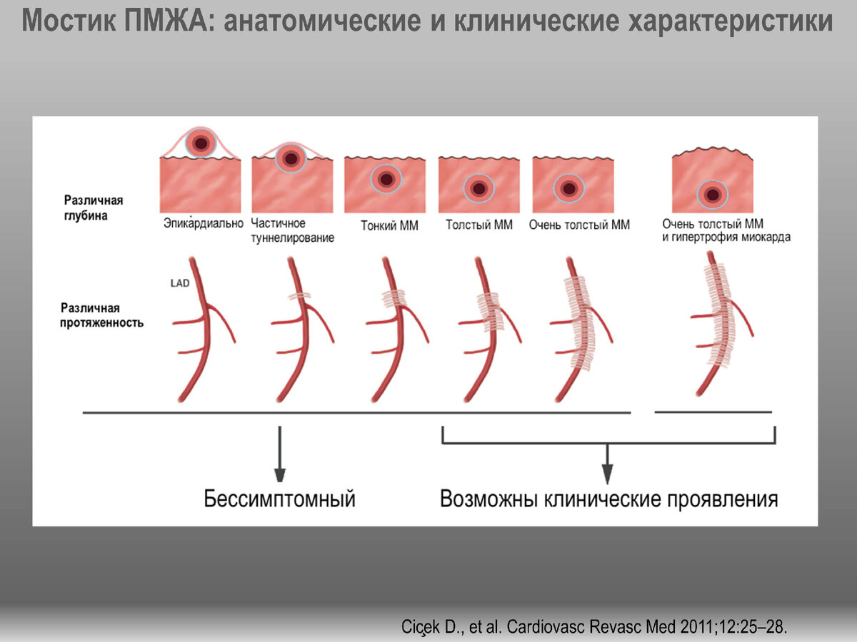 Что такое миокардиальный мостик? | Кардиолог Константин Крулёв | Дзен