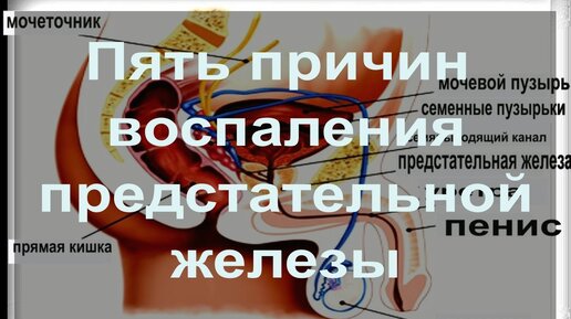Воспаление простатита. Воспалительные заболевания предстательной железы. Воспаление простатита. Доброкачественная гиперплазия предстательной железы. Воспаление предстательной железы у мужчин.