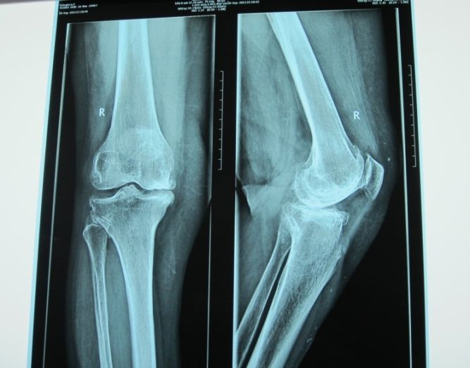 Болит сзади колена пульсирует. Почему при ходьбе болят. Почему при ходьбе болят. Ступня болит сбоку с внешней стороны пятки. Болит с внешней стороны колено сбоку болит.