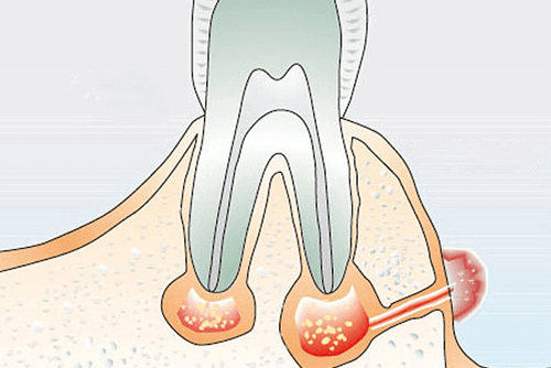 Зубной свищ на десне: причины, симптомы и лечение в стоматологической клинике