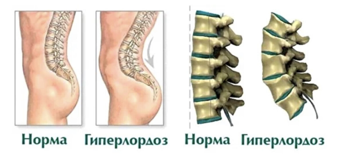 Гиперлордоз поясничного отдела
