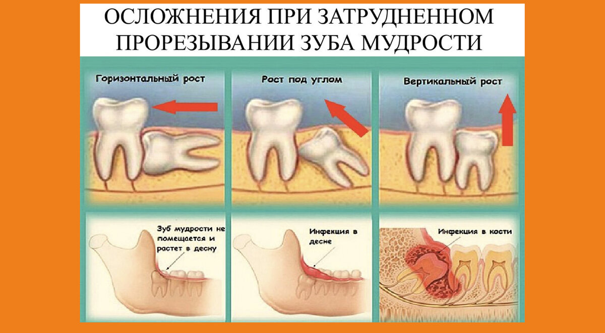 У человека вместе с зубами мудрости